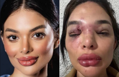Empresário desfigura rosto da esposa com taco de beisebol